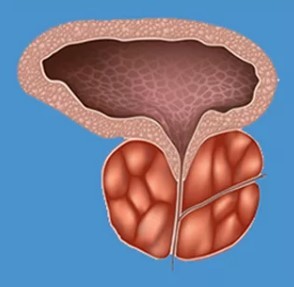 Characteristic symptoms prostatitis