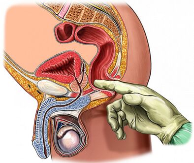 Examination of the prostate with fingers
