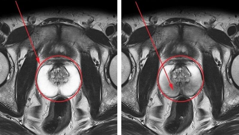 healthy and inflamed prostate with chronic prostatitis