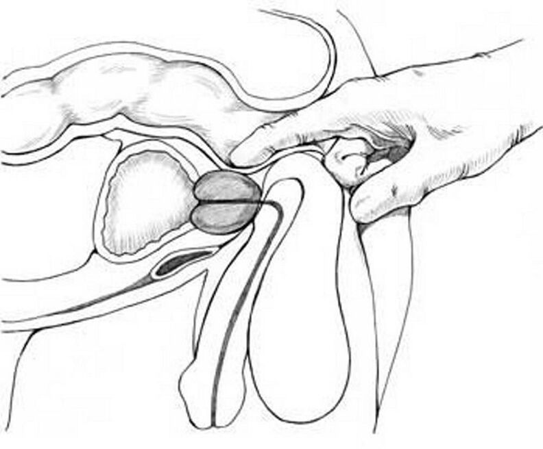 prostate massage in chronic prostatitis