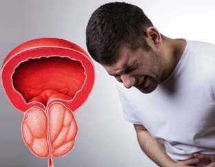 Chronic prostatitis symptoms in men