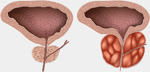 gland healthy and sick