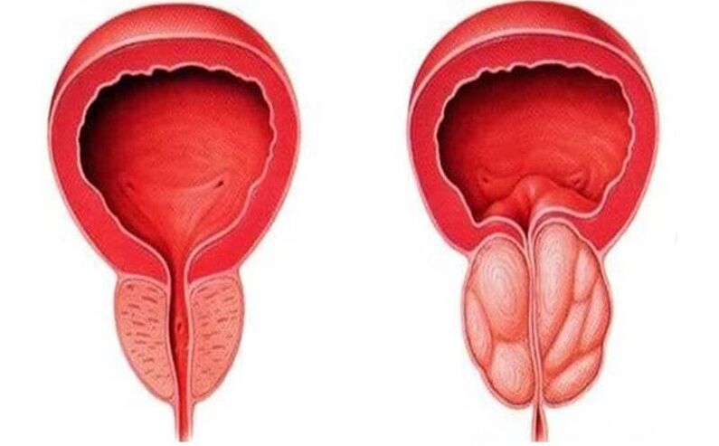 healthy and inflamed prostate with prostatitis